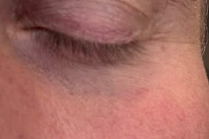 Hud runt ögat utan eye patches före användning, referensbild från praktiskt test